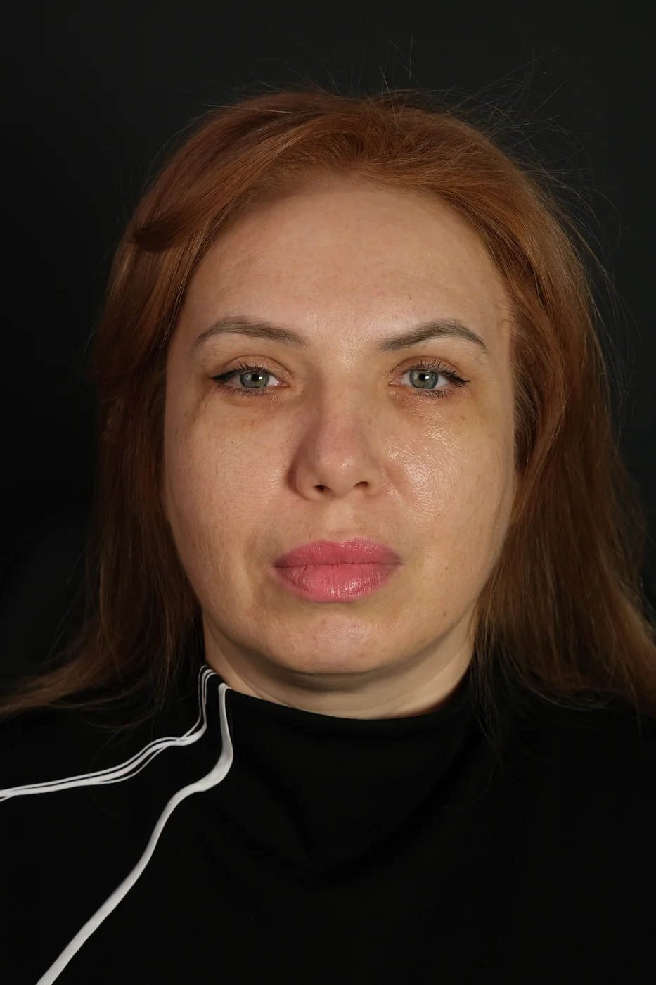 Верхняя блефаропластика — после, пара 3