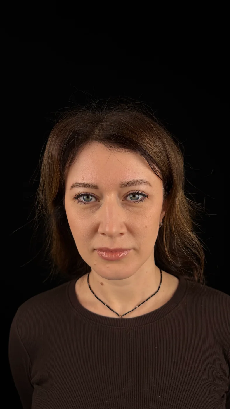Подтяжка лба и виска — после, пара 2
